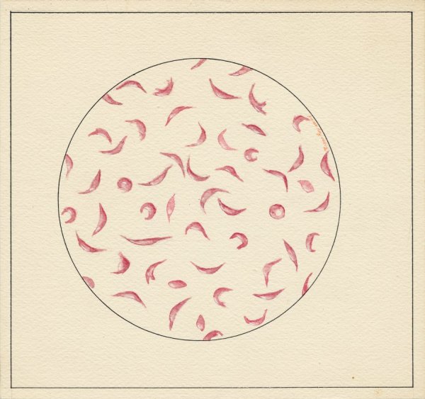 Pastel drawing of sickled Hemoglobin cells